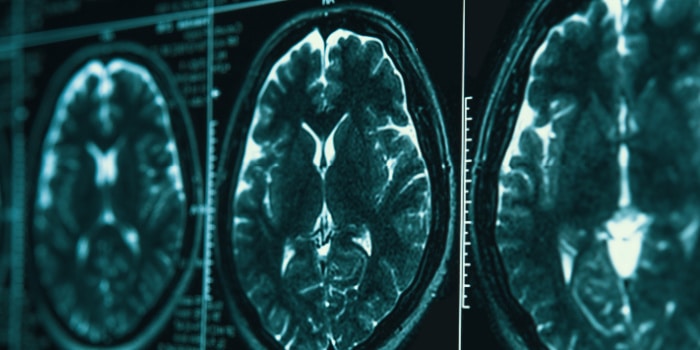 MRI of Brain